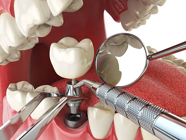 Best Chipped Tooth Repair Near Me  in Comstock Park, MI